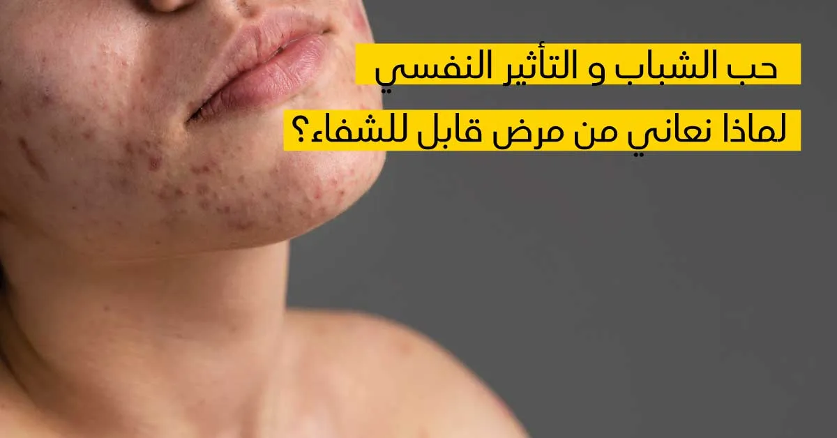  حب الشّباب والأذى النّفسي لماذا نعاني من مرض قابل للشّفاء؟